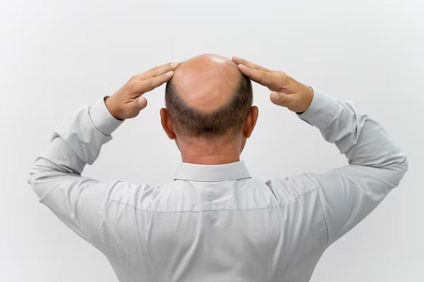 Myths and Truths of Hair Transplant