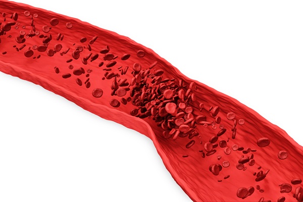 blood-clot-vein-white