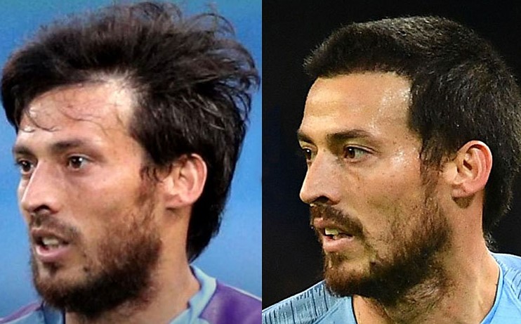 David Silva hair transplant