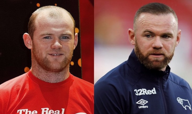 Wayne Rooney hair transplant