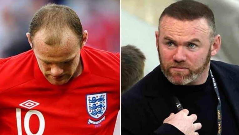 Wayne Rooney hair transplant before and after