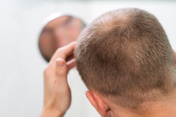 Adult male scratching scalp after infected hair transplant