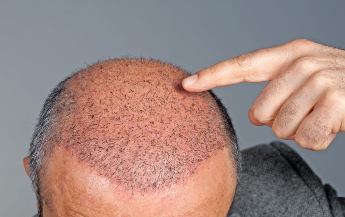 Shock Loss after hair transplant