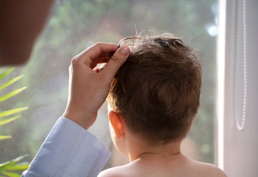 a baby child going bald with alopecia