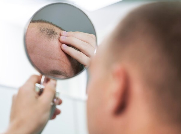male having balding problems and thinking about hair laser therapy