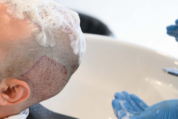 a doctor helpting patient with after care hair transplant - hair transplant expenses in mexico