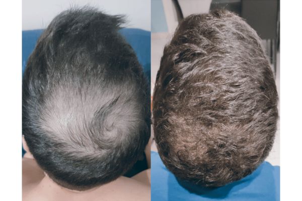 hair transplant for men before and after capilclinic change over time - types of hair transplant for men