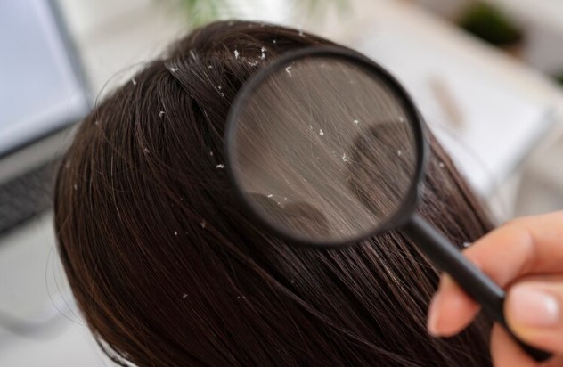 dandruff affect hair transplants