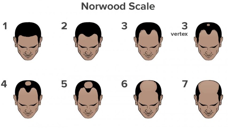 a picture showing how is the grades of norwood scale