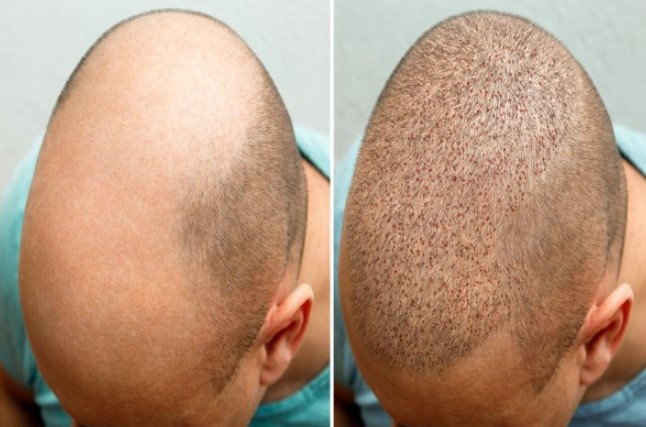 before and after hair transplant in bald man - hair transplant without shaving