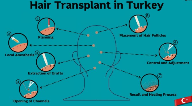 A clear infographic showing the sequential stages of a hair transplant procedure—harvesting follicles, preparing the recipient site, and implantation—highlighting Turkey’s clinical setup