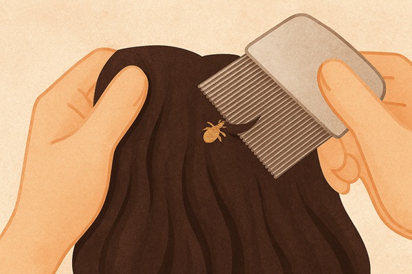 Illustration of hands applying liquid lice treatment to infested hair