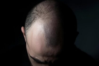 Complete Guide to Alopecia Types, Causes, and Diagnosis