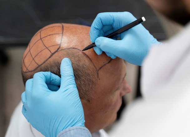 best hair transplant in USA